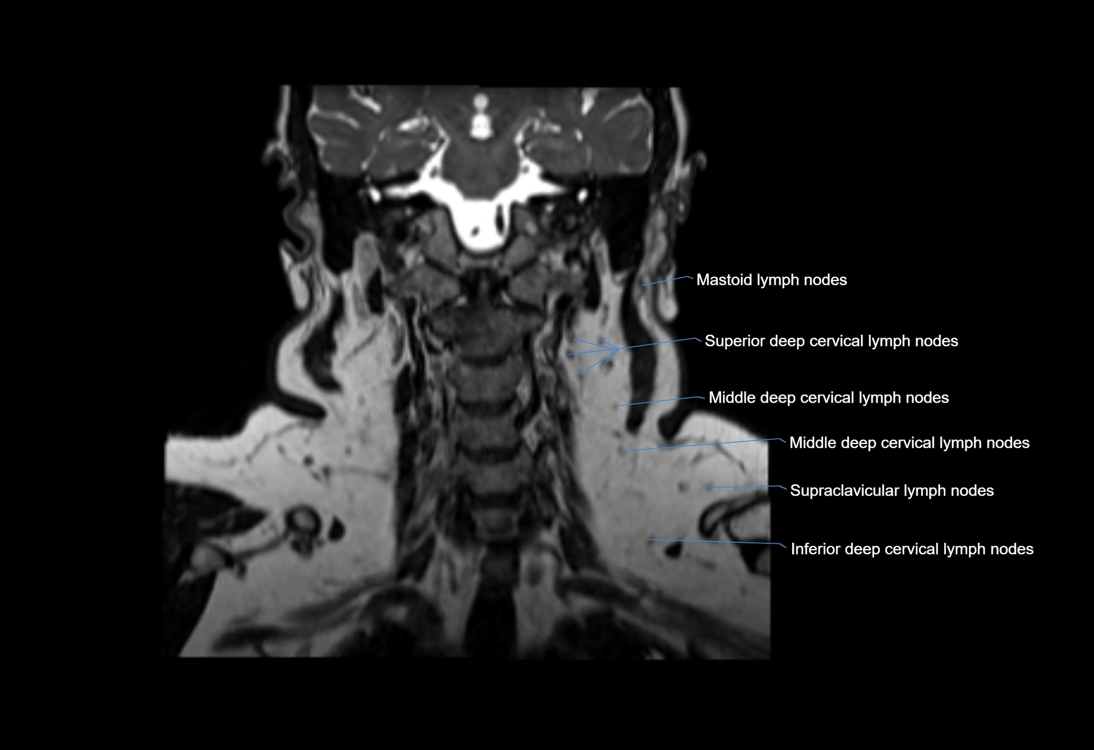 Neck coronal lymph node cross sectional MRI anatomy 3T MRI  image-img-00001-00030.webp